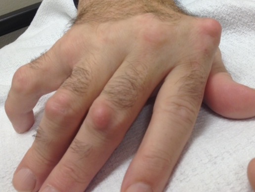 Rheumatoid Nodules